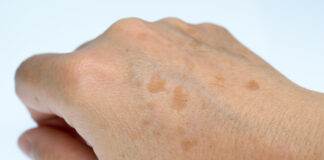 Hands Of A Woman Suffering From Age Spots