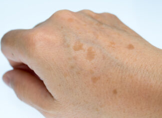 Hands Of A Woman Suffering From Age Spots