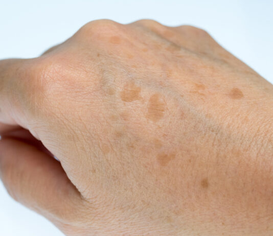 Hands Of A Woman Suffering From Age Spots