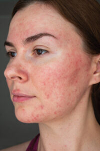 Papulopustular Rosacea, Face Close Up