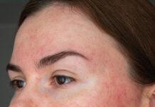 Papulopustular Rosacea, Face Close Up