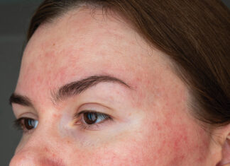 Papulopustular Rosacea, Face Close Up