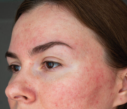 Papulopustular Rosacea, Face Close Up