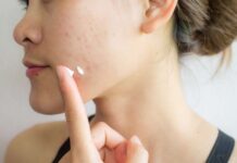 Tretinoin Picture Ii