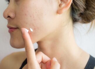 Tretinoin Picture Ii