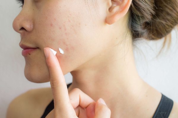 Tretinoin Picture Ii